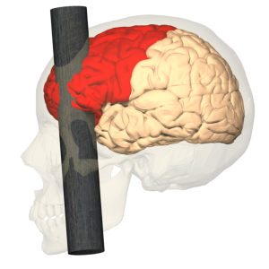 Head Injury of Phineas Gage